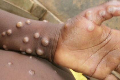 ministerio-da-saude-afirma-que-sus-esta-apto-para-diagnostico-precoce-da-mpox